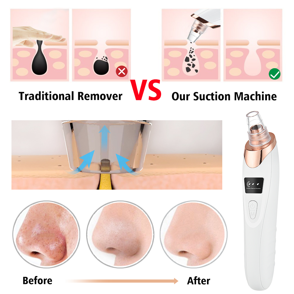 Rimozione di punti neri Aspira - Nasal Aspirator recensione e prezzo